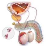 vasectomy
