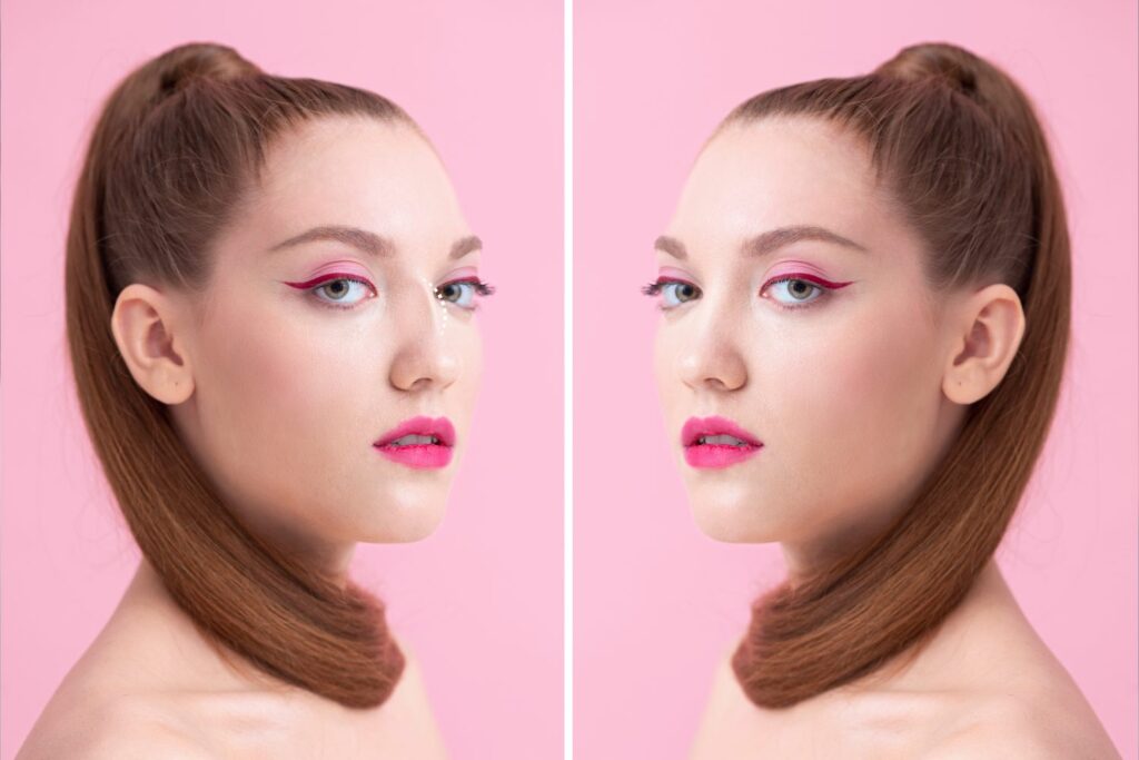 Rhinoplasty Before and After